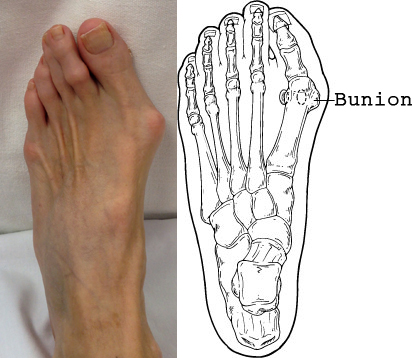 Bunion Bunion